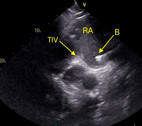 Ultrasound image showing how the biopsy is guided in real time. The opened biopsy forceps can be seen inside the right atrium (RA), positioned against the intravenous tubercle (TIV) to ensure safe and precise sampling. Transvenous heart biopsy in a standing horse equine medicine