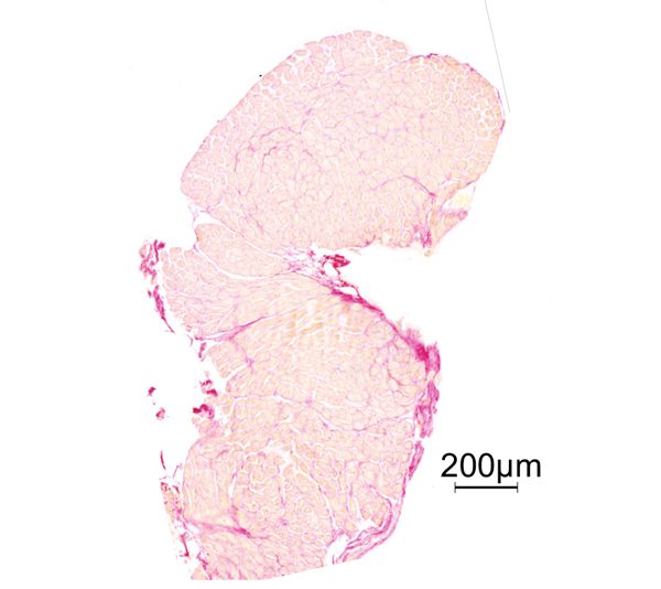 Microscopic image of an RA tissue sample obtained using this technique, Picro-Sirius Red stained to highlight the structure of the atrial muscle. The image illustrates that high-quality myocardial tissue can be obtained without the need for general anesthesia or open-chest procedures. Scale bar: 200 μm. Transvenous heart biopsy in a standing horse equine medicine